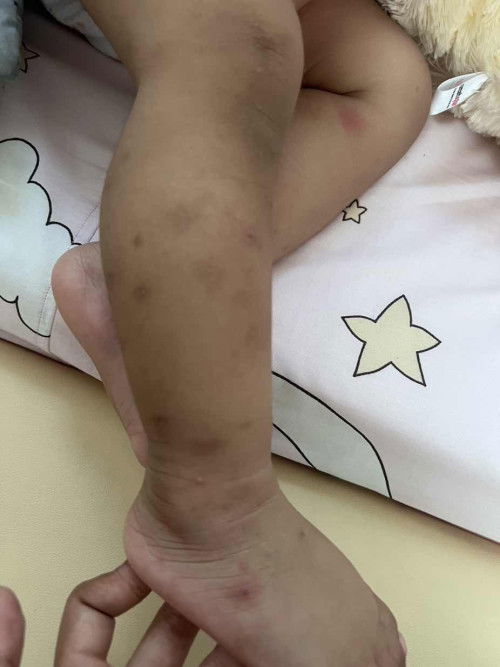 Permasalahan Kulit sensitif pada Anak