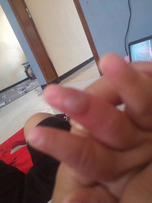 Gatal bengkak melepuh di jari tangan bayi