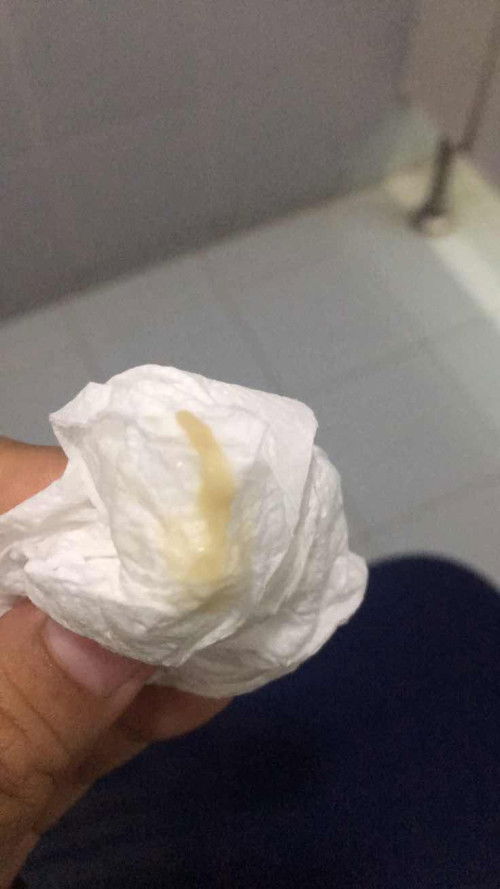 ท้อง12wแต่มีมูกเลือกบ่นน้ำตาลแบบนี้บางค่ะ