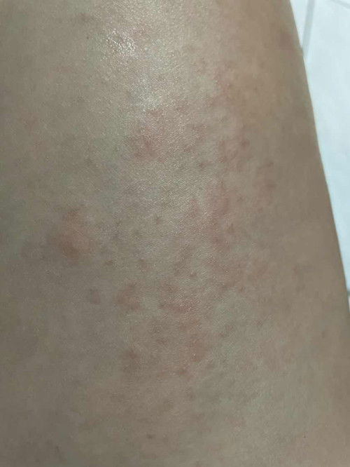 Alergi atau hormonkah pas hamil gatal2 ?