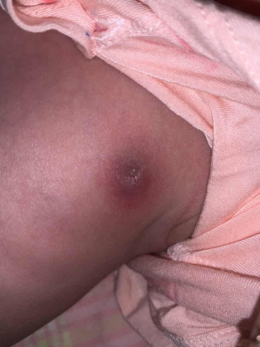 Bé nhà e mới sinh được 2 tuần nhưng hôm nay vú bé bị sưng đỏ và cứng các mon biet bé bị gì hk ạ🥹