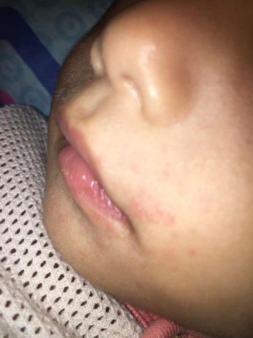 ruam dekat area mulut