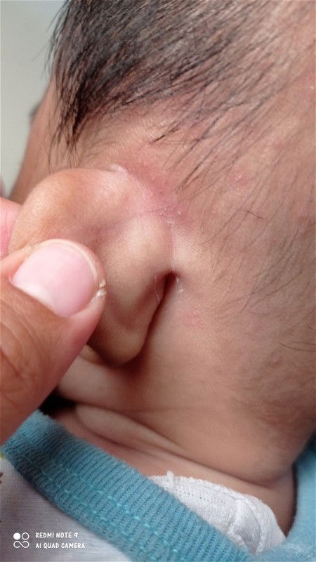 Bayi ku umur 5 bln bklang telinga nya gatel beruntus merah kya biang keringat gtu,ap obat nya bun?
