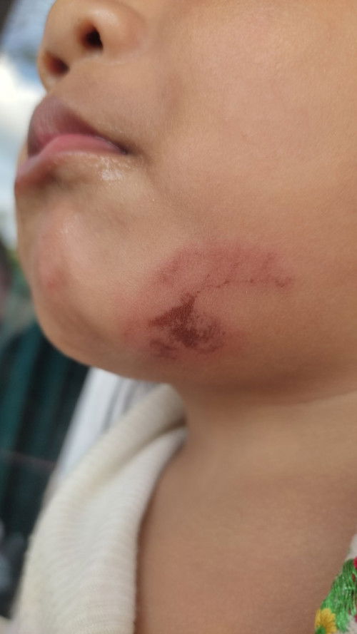 Hitam pada bawah dagu