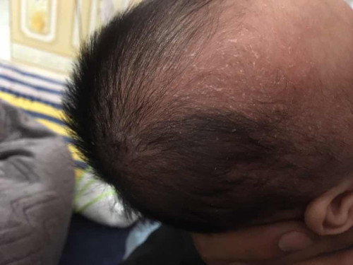 Bé có phải bị nấm đầu ko hay bị sao