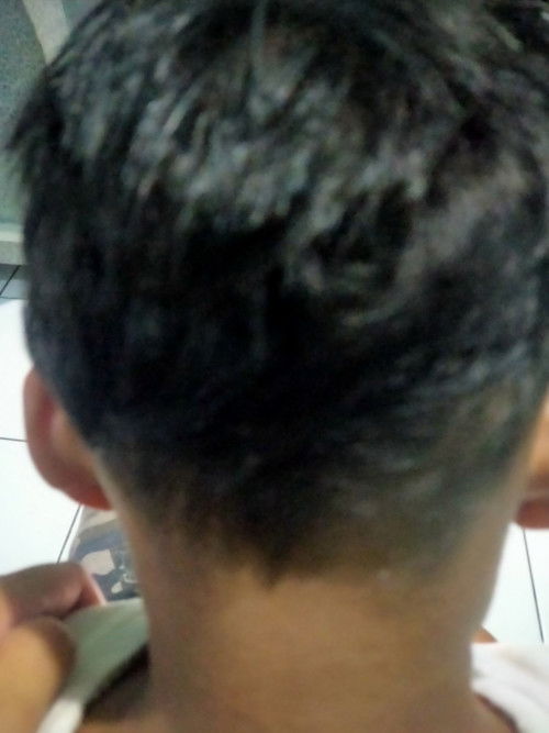 Benjolan disekitar belakang telinga