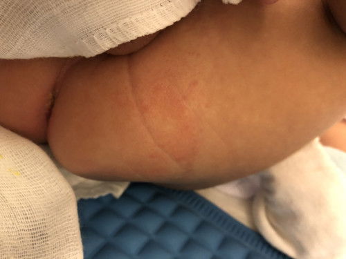 Diaper rash