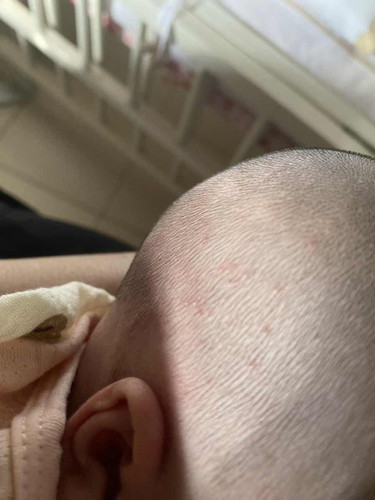 Hi semua. Nak tanya kenapa ya kat kepala baby naik mcm ni? Merah2 and bintik2 mcm peluh. Risauuuu