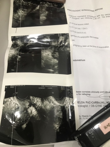 8 weeks No baby found in TVS