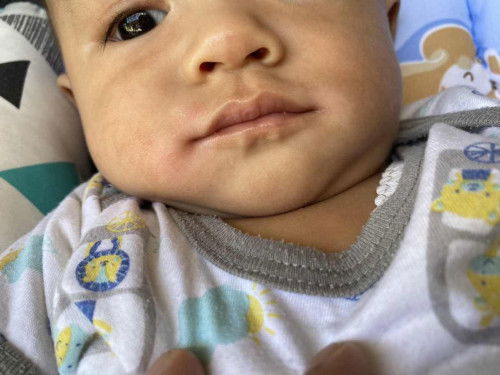Putih seperti panu di wajah bayi
