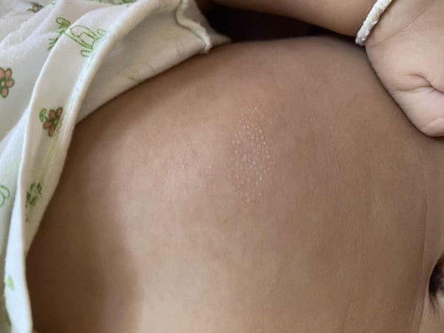 น้องมีตุ่มเล็กๆใสๆแบบนี้