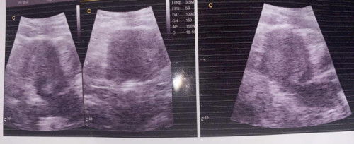 testpack positif pas usg tidak ada kantong kehamilan