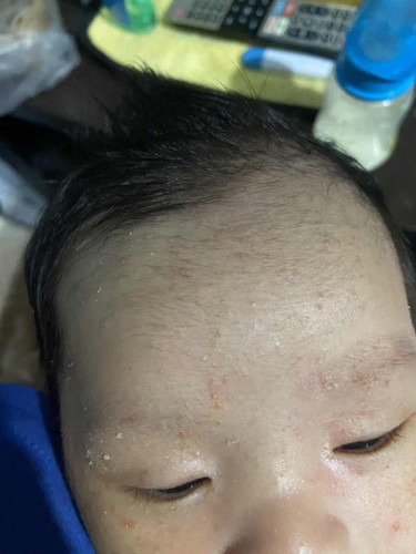 Baby acne?