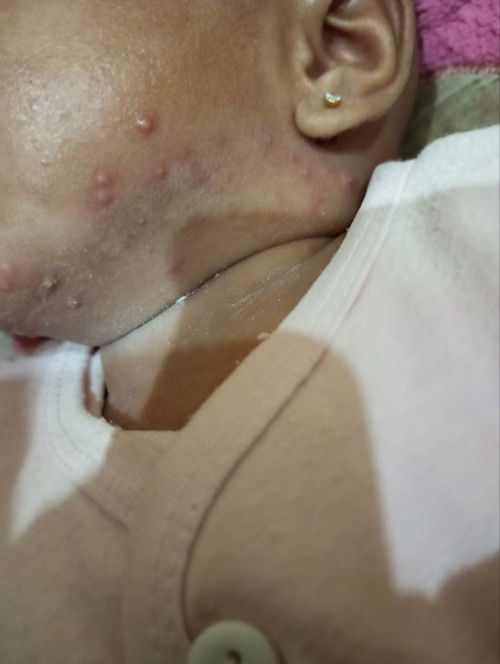 Bayi 3 bulan banyak bintik seperti jerawat / bisul di wajah dan leher