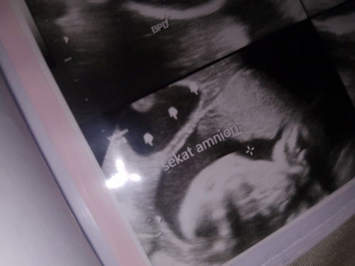 Disuruh dr ga usah dipikirkan tapi kepikiran terus 😭