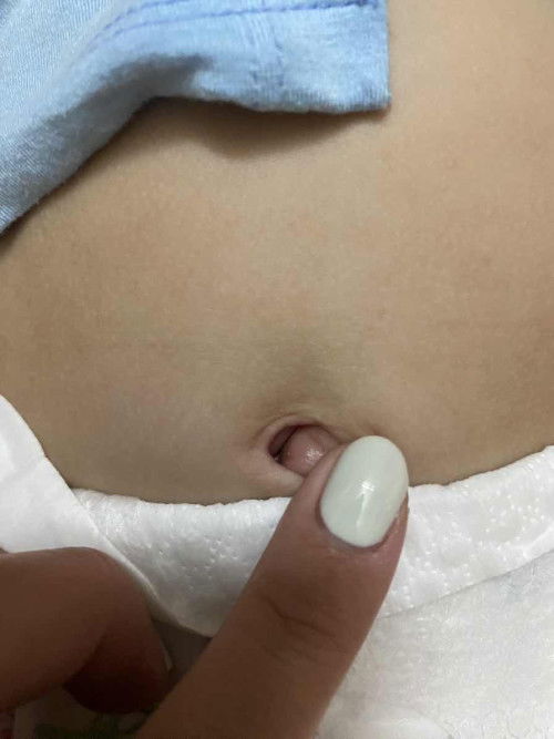 tự dưng rốn em bé nhà e bị đóng vảy hơi bẩn xong vệ sinh thì thấy đỏ ở trong và có mùi hơi hôi.