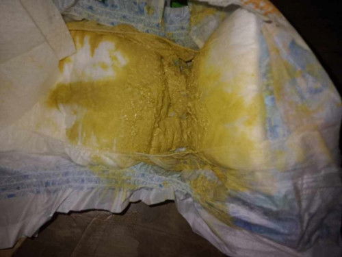 Hello po sana mapansin post ko tanong kulang normal po ba ang ganitong tae ni baby? Fmilk si baby