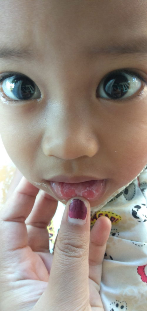 Mulut anak berjamur/sariawan