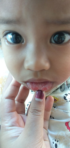 Mulut anak berjamur/sariawan