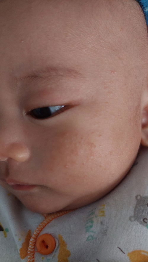 Bun ada yg pernah baby nya bintik kaya beruntusan gitu ga di pipinya?