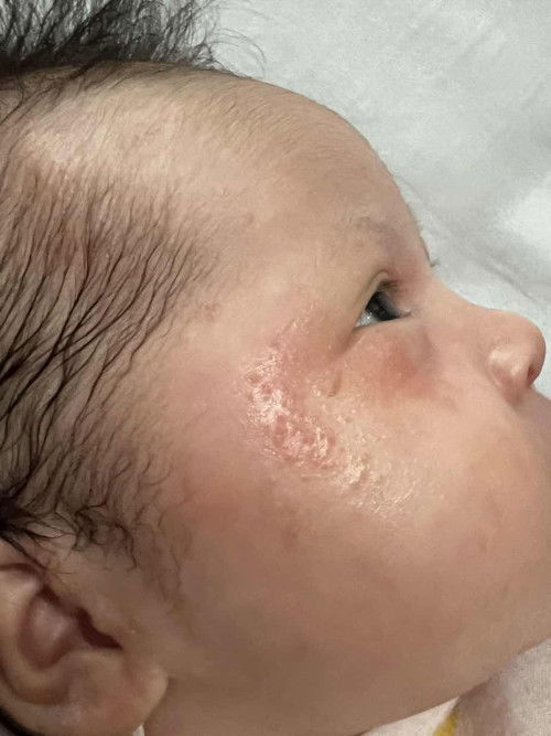 ผดอะไรคะ ขึ้นที่หน้า