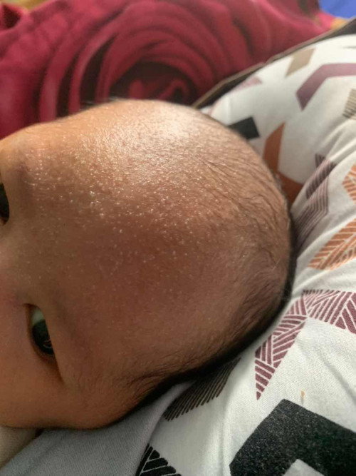 Beruntusan wajah bayi usia 5hari