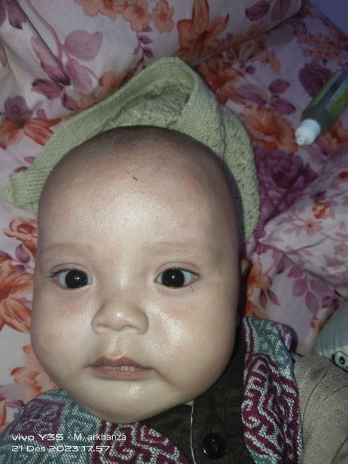Anak saya 5 bulan 3 hari tapi mukanya begini bun.. Kasian gegaruk mulu.. 🥲🥲