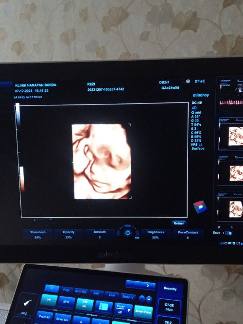 USG pass kadungan 6 bulan cewek