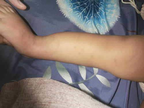 Apakah ada Cream penghilang bekas gigitan nyamuk