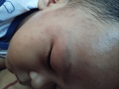 Bun ,anak saya 1 tahun selasa habis demam tinggi ,Tapi kmaren bintik merah skrg tambah merah 1 badan