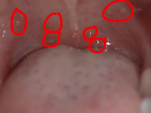 แผลในปาก 
สวัสดีค่ะ ลูกชายไม่สบายเมื่อวาน วันนี้พึ่งสังเกตดูว่าน้องมีแผลในปาก มีแม่ๆคนไหนเจอแบบนี้บ้างคะ แล้วรักษายังไงกันคะ 🙏🏻
