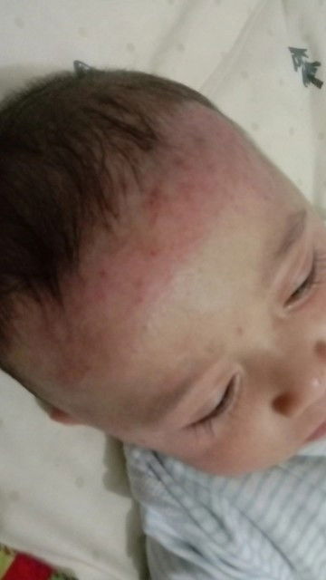 Kulit anak iritasi/alergi