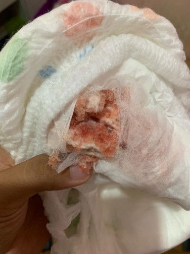 Pipis darah Bayi 8 bulan