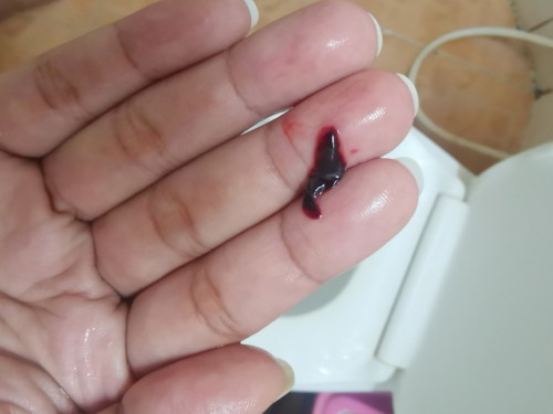 ท้อง8สัปดาห์ มีเลือดออกเป็นลิ่ม