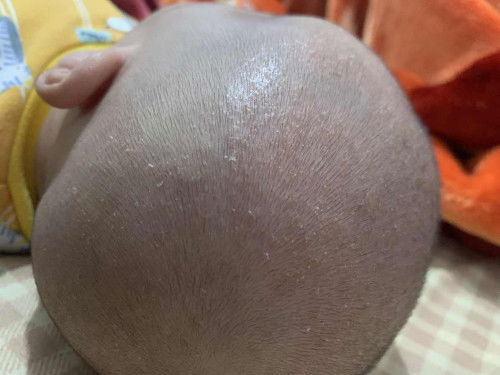 Kepala bayi kering berkerak