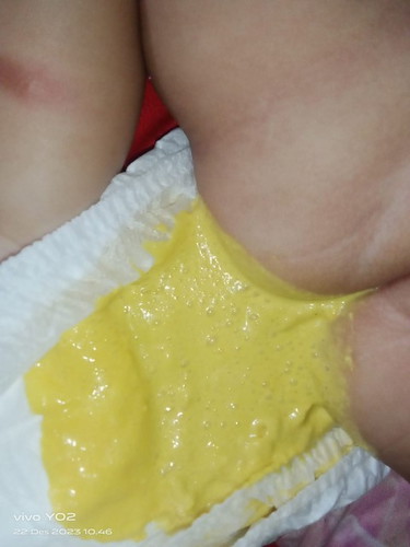 Normal gak sih Bab Anak u3bulan.. bab nya encer terus agak berbusa