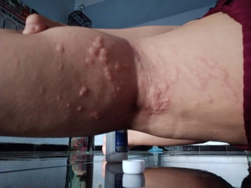 gatal gatal pada busui