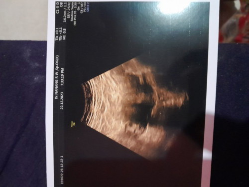 apakah ada miom karena diminta dokter untuk hamil