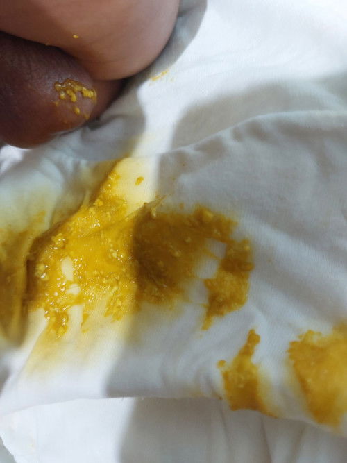 Warna pup bayi diare