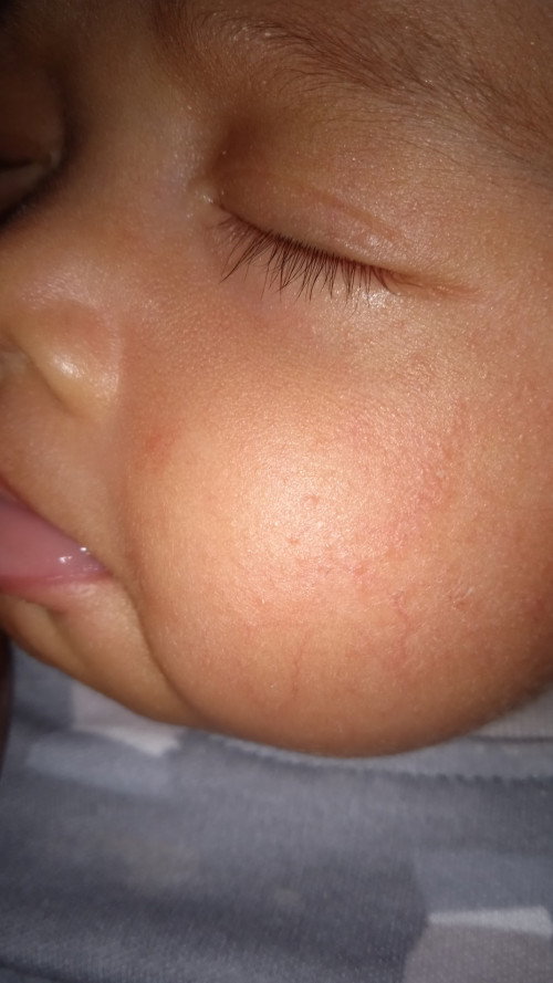 Bintik merah di wajah bayi