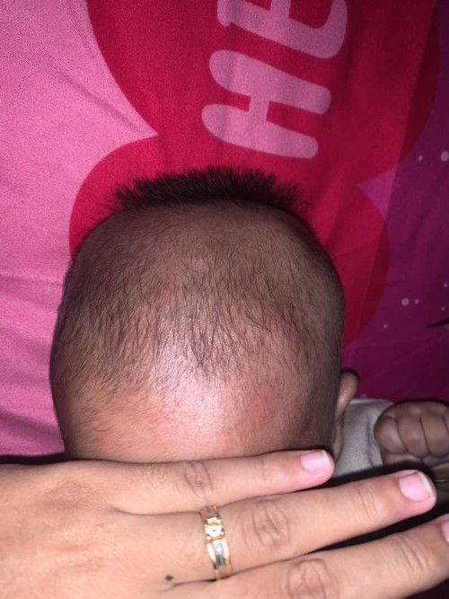 Kulit kepala beruntusan dan kering