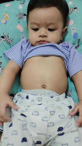Tulang rusuk bayi besar/menonjol