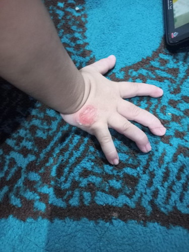 Gatal² di kulit bayi obatnya apa yaa bund,awalnya bintik² berisi air kemudian pecah terus melebar