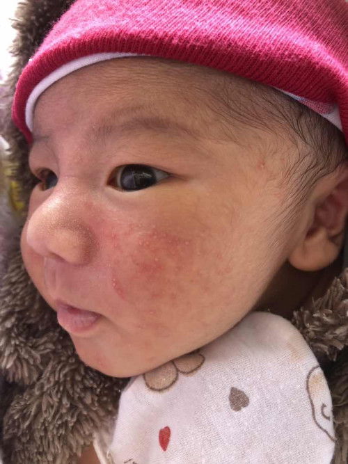 ผื่นไหมคะแบบนี้