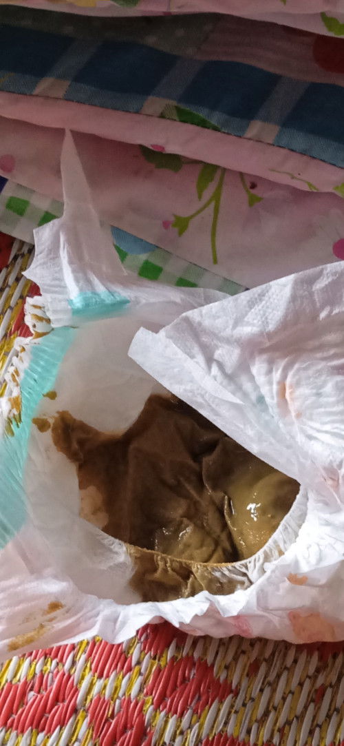 สีอุจาระแบบนี้ปกติไหม