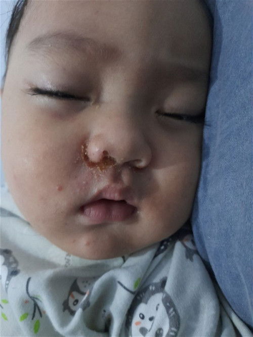 ini impetigo atau alergi ya bund
