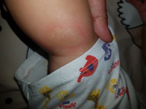 namula parang kagat ng lamot  nun umaga nun gabi nagtubig parang ubas