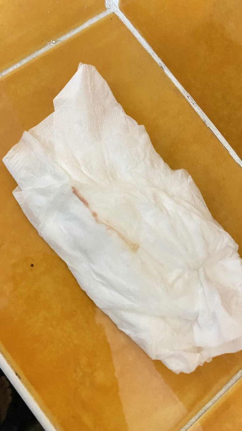 ฉีดกันแท้ง 2 เข็มแล้ว เลือดยังออก กังวลมากค่ะ