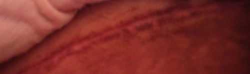 Bekas sc. Nyeri di dalam