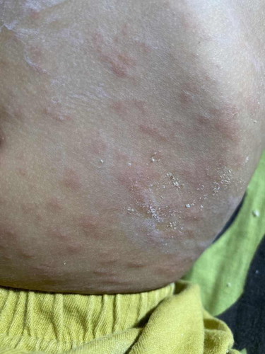 Muncul ruam merah di badan anak 1 tahun kenapa ya bund?